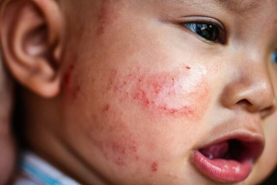 Qida allergiyası nədir? Qida allergiyasının simptomları və müalicəsi
