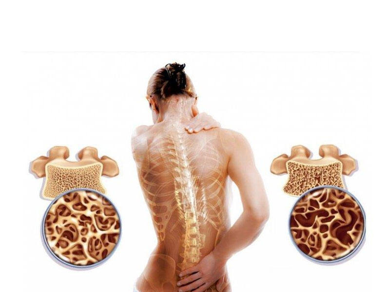 Osteoporozun risk faktorları